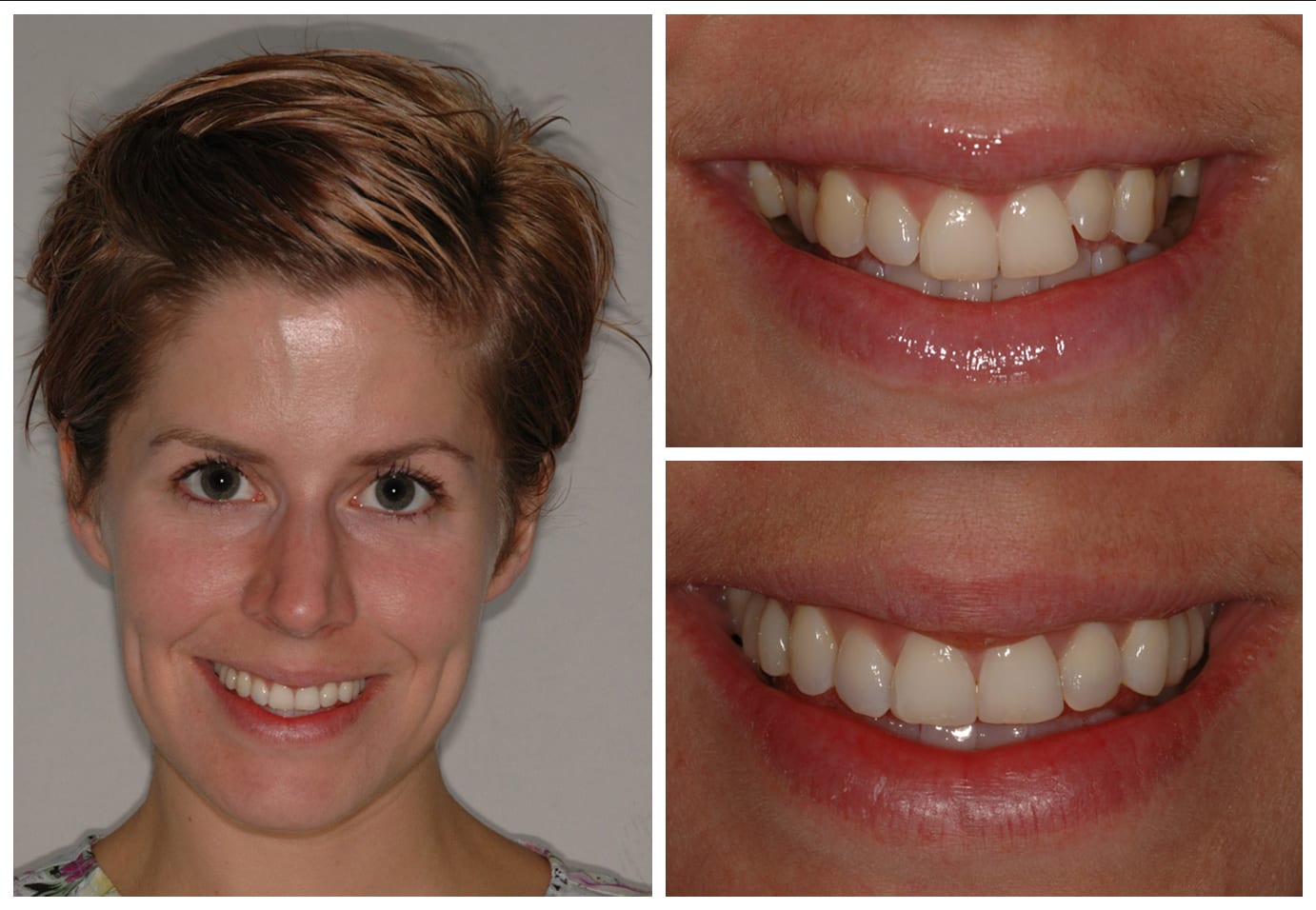 Cosmetic dentistry before and after photo