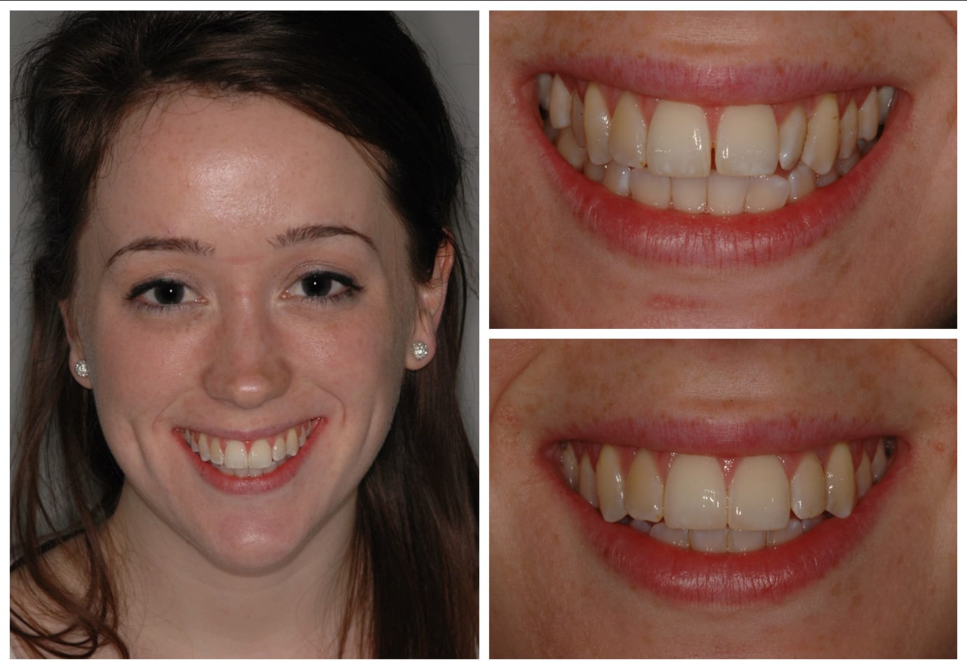 Cosmetic dentistry before and after photo