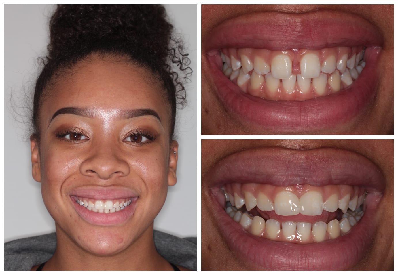 Before and after photo cosmetic dentistry