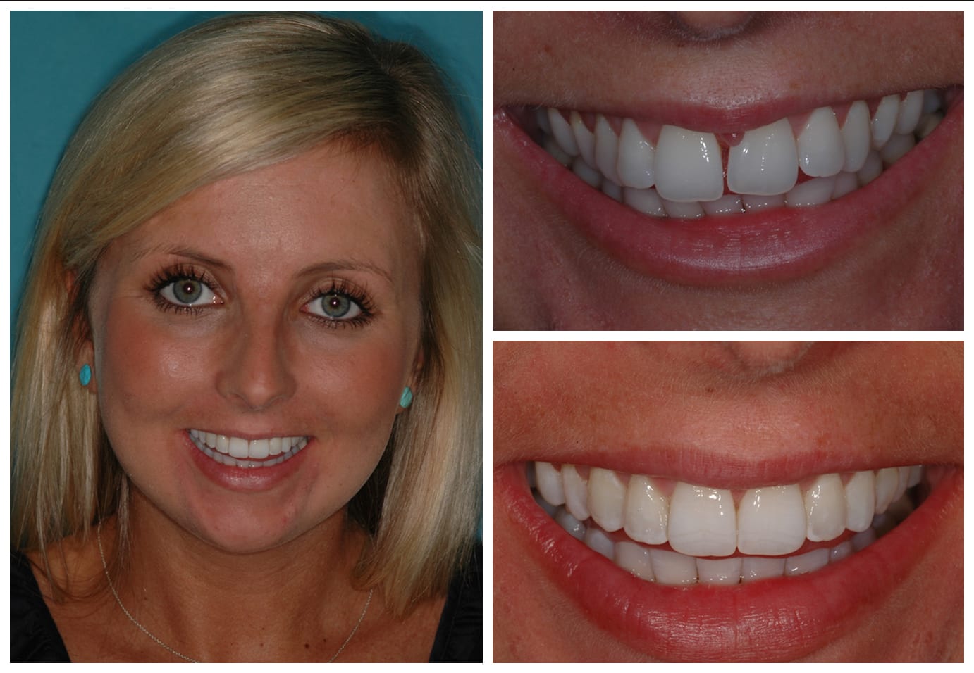 invisalign before and after photo