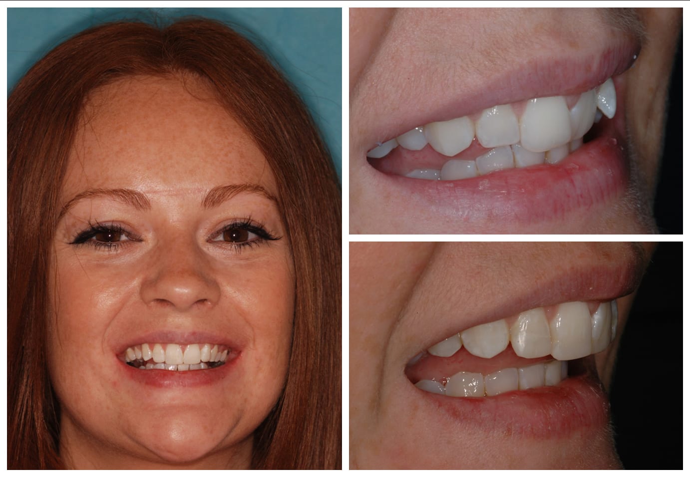 before and after image of invisalign patient