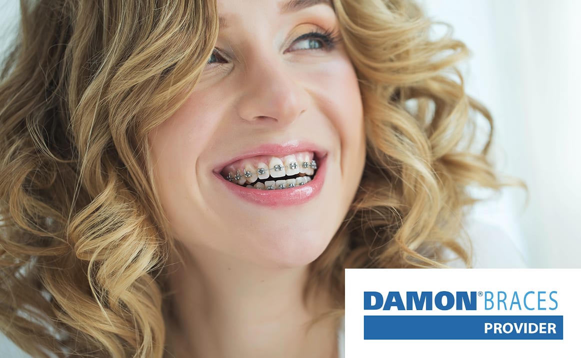 Damon Braces are the closest in look and feel to the traditional fixed braces