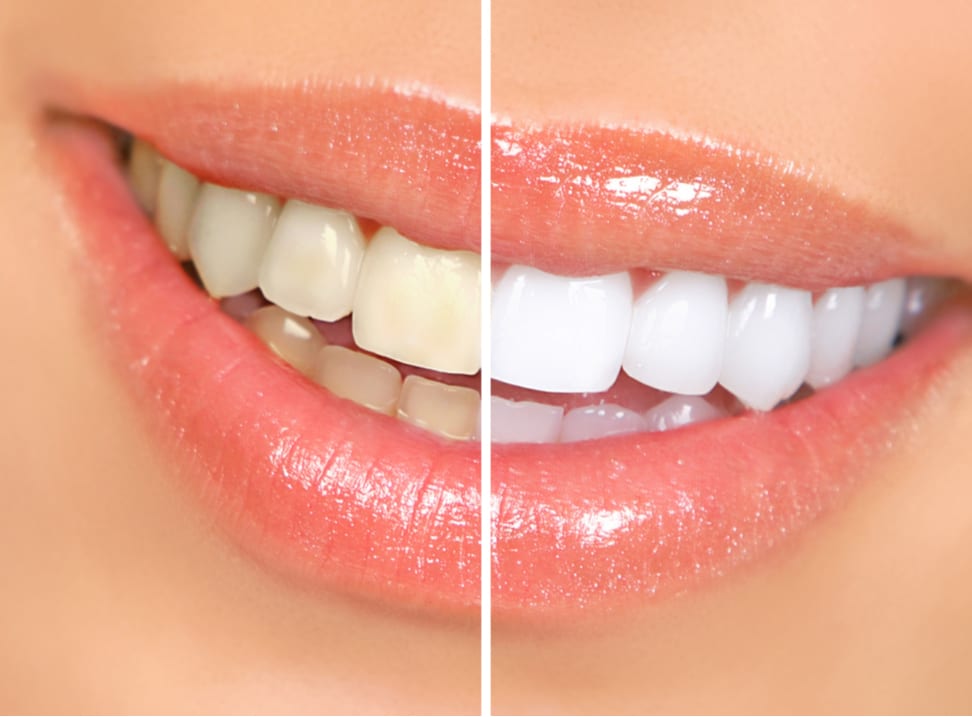 Teeth whitening treatments