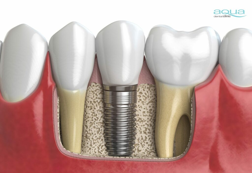Knowing if you are a suitable candidate for implants can determine which treatment you are recommended.