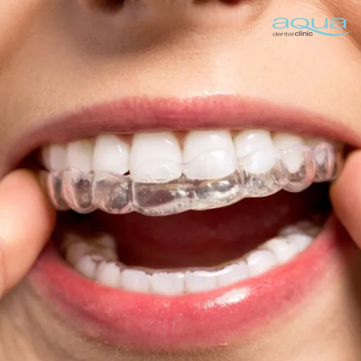 invis clear aligners